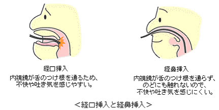 経口挿入と経鼻挿入